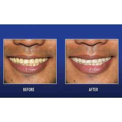 The Enamel Preserving UV Teeth Whitener 1